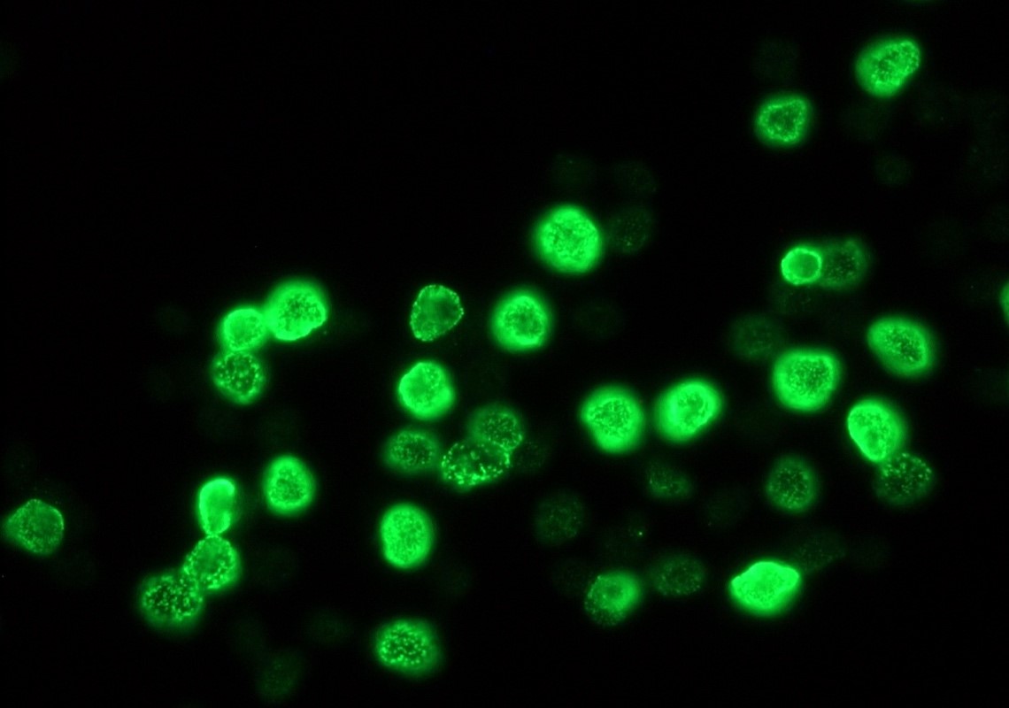 Figure 5. Indirect immunofluorescence staining of BrdU-labeled MR65 lung cancer cells using MUB0200P (IIB5; diluted 1:1000).
